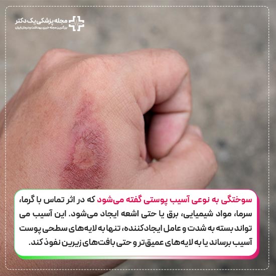 سوختگی جزئی دست