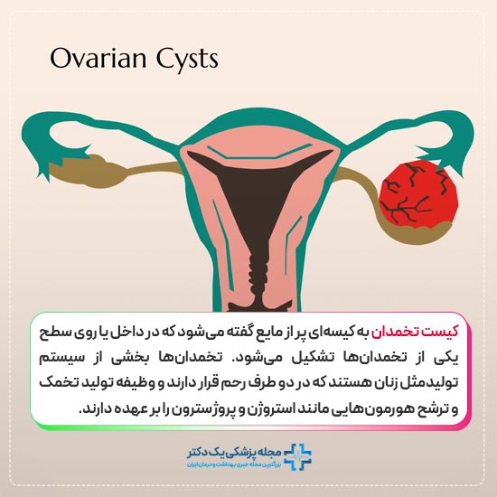 کیست تخمدان