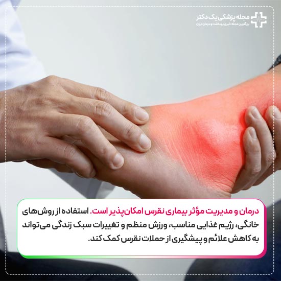 کنترل بیماری نقرس