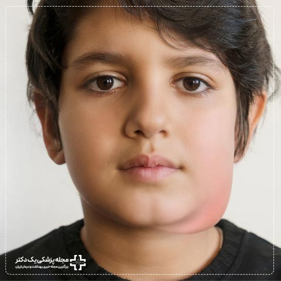 بیماری اوریون در کودکان