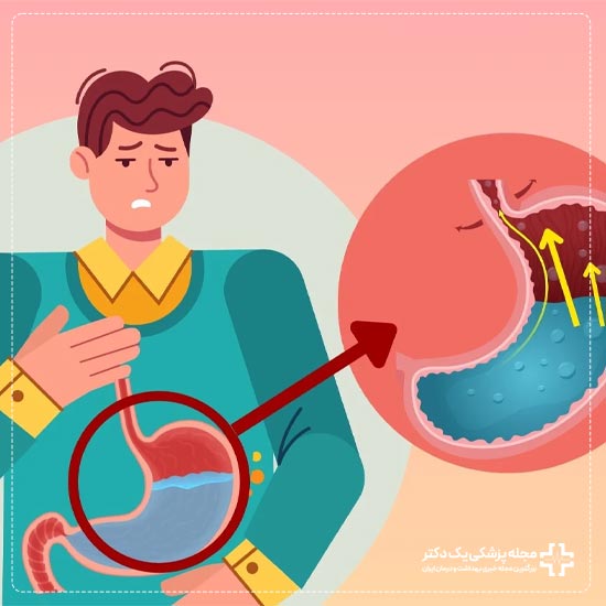 ریفلاکس اسید