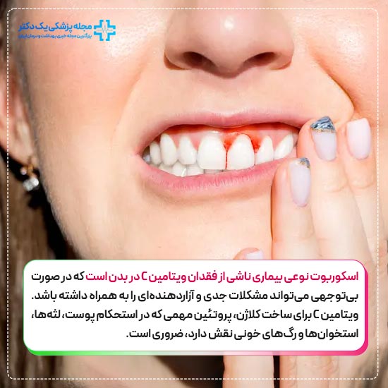 بیماری اسکوربوت