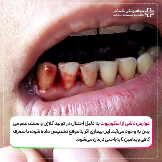 عوارض بیماری اسکوربوت