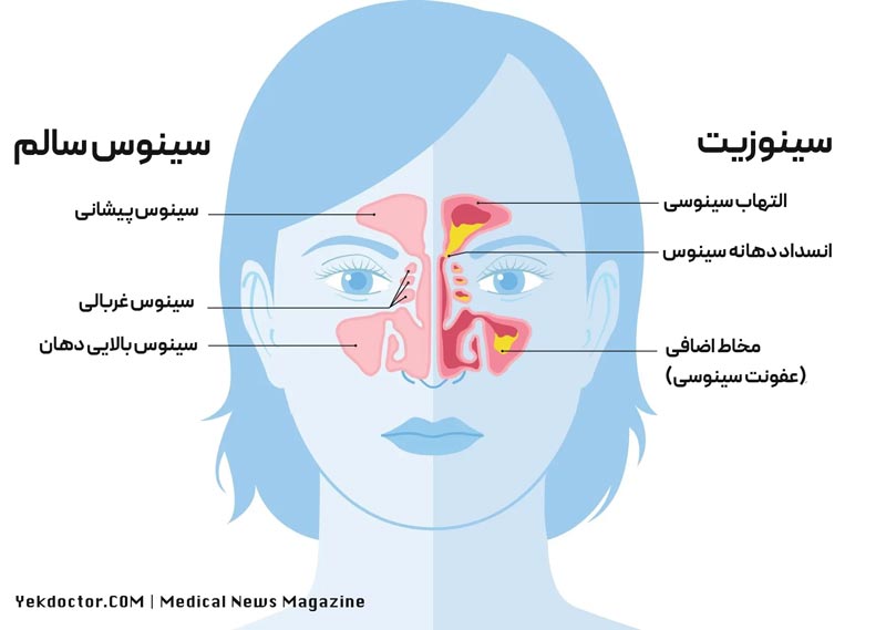 اینفوگرافی سینوس سالم و سینوزیت