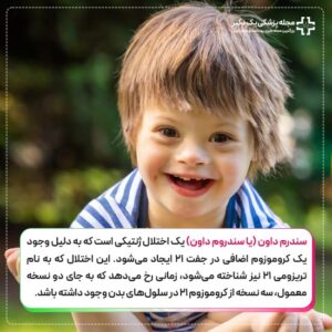 سندرم داون