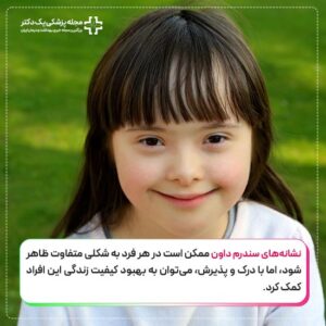 سندرم داون