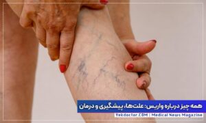 درمان واریس