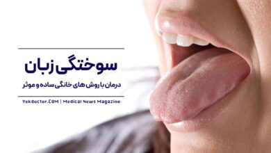 سوختگی زبان