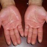 عرق کردن کف دست چه راه حل‌هایی دارد؟دلیل آن چیست؟