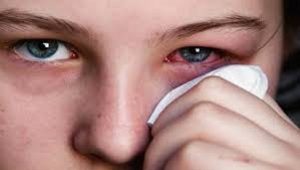 عوامل موثر بر قرمز شدن چشم و روش های کاهش و درمان آن