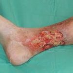 زخم ساق پا چرا و چگونه به وجود می آید؟ بررسی علائم و روش تشخیص آن