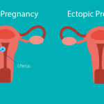 بارداری خارج از رحم (Ectopic Pregnancy) ؛ علل و نشانه های این عارضه
