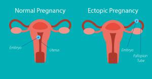 بارداری خارج از رحم (Ectopic Pregnancy) ؛ علل و نشانه های این عارضه