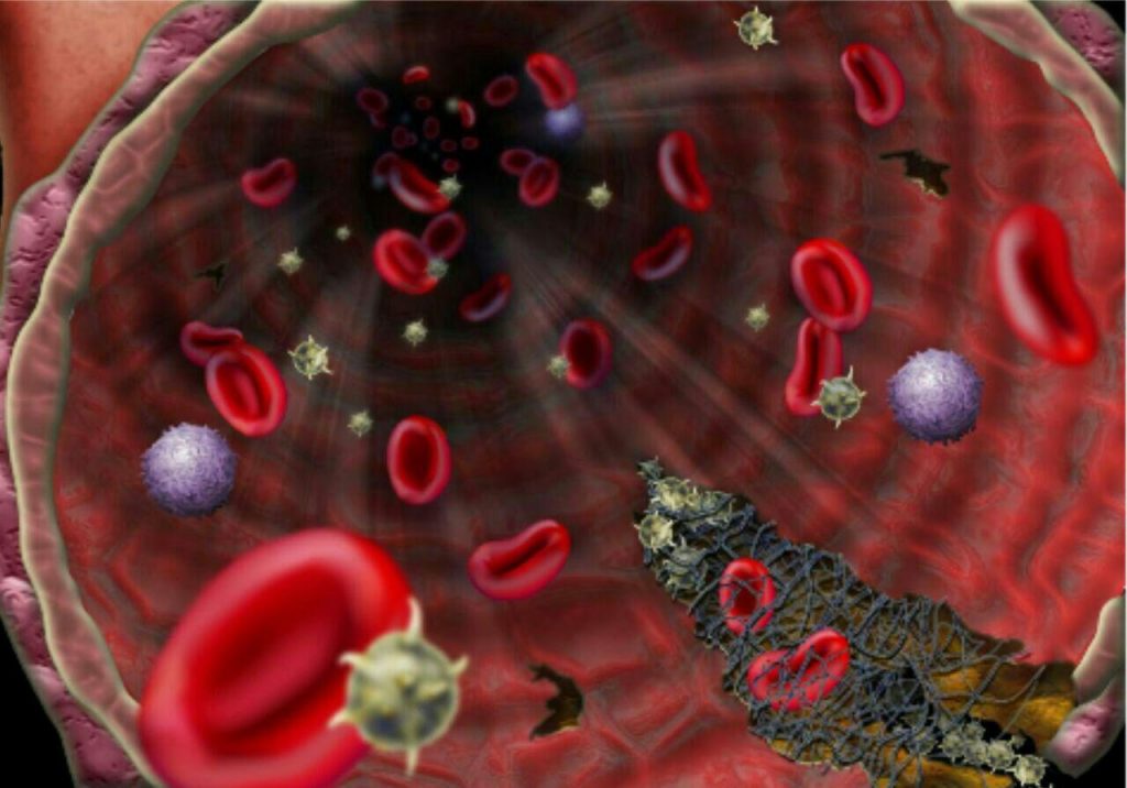 ترومبوسیتوپنی یا کاهش پلاکت خون چیست و چگونه درمان میشود ؟