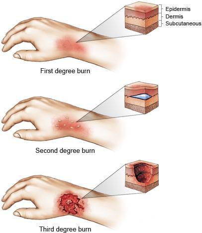 بهترین روش های طبیعی برای درمان سوختگی در انگشتان، صورت و دیگر اندام ها
