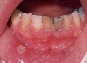 آفت دهان و زبان