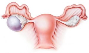 بیماری های تخمدان