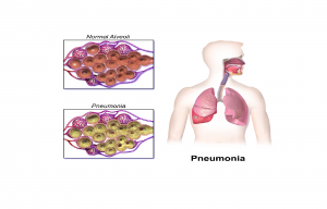 پنومونی / پنومونی چیست، چه علائمی دارد و چگونه درمان می شود؟