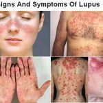 بیماری لوپوس چیست ؟ آشنایی با عوامل بروز لوپوس و درمان آن