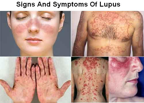 بیماری لوپوس