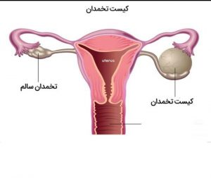کیست های تخمدان |انواع کیست های تخمدان و علائم وجود کیست در تخمدان