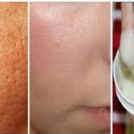 درمان خانگی منافذ باز پوست ، بهترین درمان برای منافذ پوست