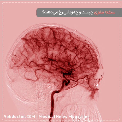 پیشگیری از سکته مغزی