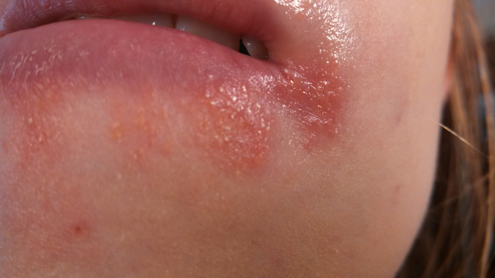 How To Get Rid Of Red Rash Around Lips