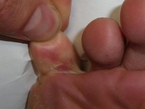 قارچ انگشتان پا / چگونه از ابتلا به عفونت قارچی پا جلوگیری کنیم