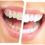 جرم دندان | چگونه جرم دندان هایمان را در منزل کاهش دهیم؟