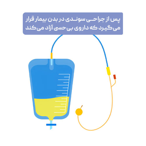 عوارض جانبی فالوپلاستی