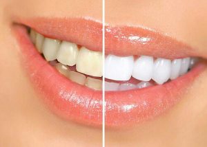 لمینت دندان | انواع لمینت دندان چیست؟قیمت لمینت هر دندان چگونه است؟