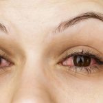 رفع سرخی چشم / راه ساده اما موثر برای درمان سرخ شدن چشم ها