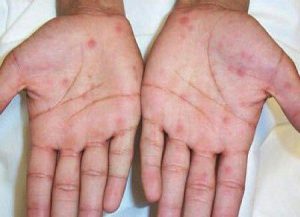 بیماری سیفلیس | علل و علائم و چگونگی درمان بیماری سیفلیس