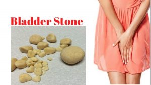 سنگ مثانه / علل ، علایم و درمان و پیشگیری از سنگ های مثانه