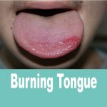 درمان سوختگی زبان با استفاده از روش های شگفت انگیز در خانه