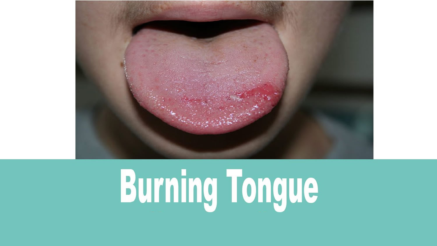 درمان سوختگی زبان 