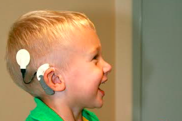 Cochlear implant students dissertation