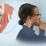دیسفاژی یا اختلال بلعیدن چیست ؟ علل ، علایم و درمان دیسفاژی