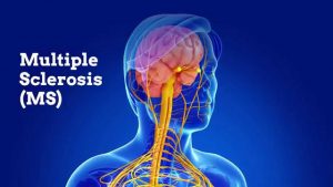 MS / علائم اولیه بیماری MS یا مولتیپل اسکلروزیس چیست؟