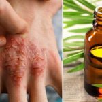 روغن درخت چای  /  مشکلات پوستی را با روغن درخت چای درمان کنید.