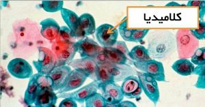 علت و علائم بیماری کلامیدیا چیست و چگونه کلامیدیا را درمان کنیم؟