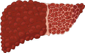 سیروز کبدی