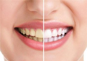 سفید کردن دندان ها بدون هیچ گونه هزینه ای
