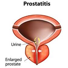 پروستاتیت 