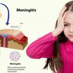 علل و علائم بیماری مننژیت چیست و چگونه این بیماری را درمان کنیم؟