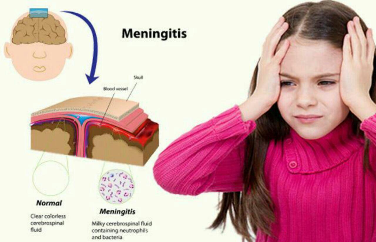 بیماری مننژیت