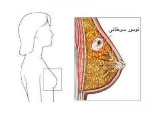 سرطان سینه
