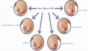 سرطان سینه