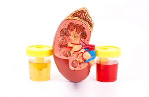 عفونت مثانه